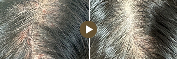 顯微鏡下頭皮治療前後對比