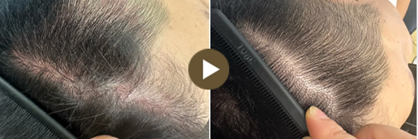 顯微鏡下頭皮治療前後對比