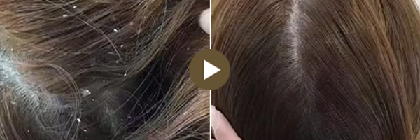 頭皮治療前後對比