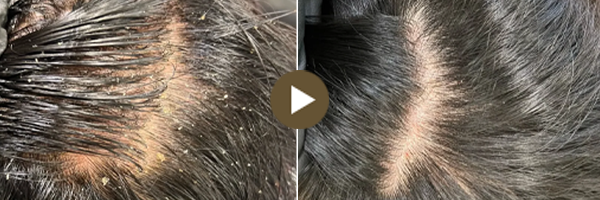 頭皮治療前後對比